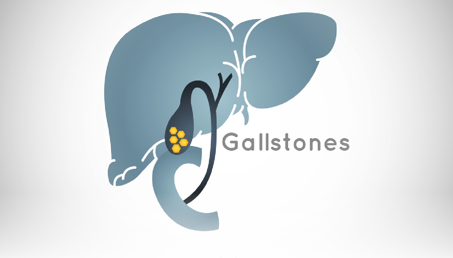Obesity and Gallbladder Stones- How are they related?